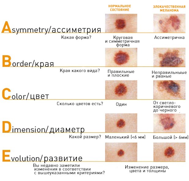 Меланома. Правило A-B-C-D-E.