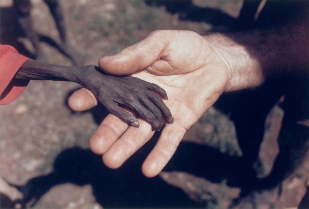 Болезненная рука голодающего ребенка