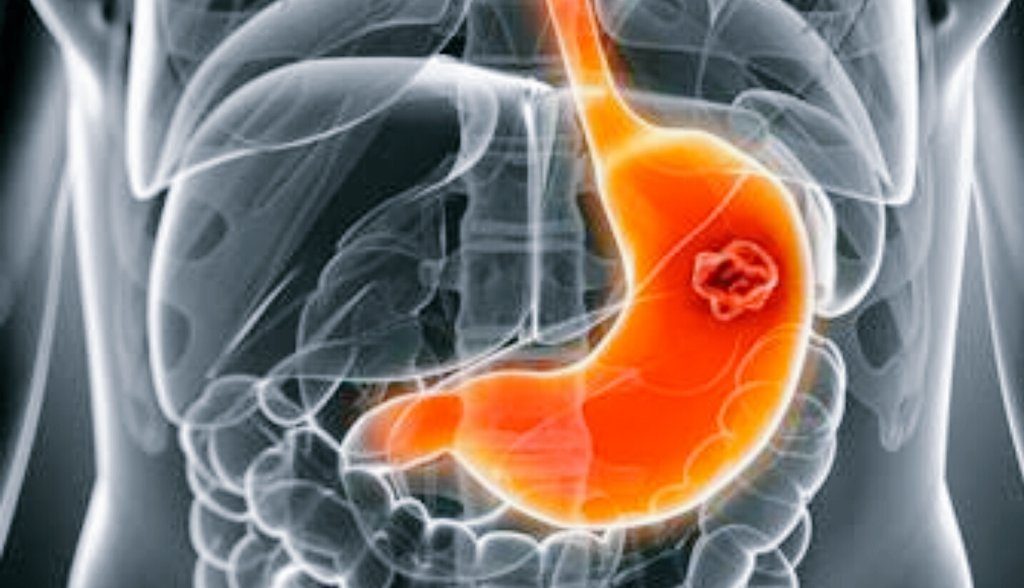 индуцированная гастропатия