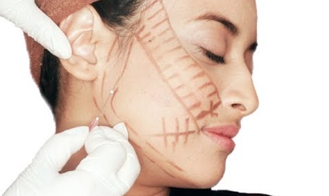 нитевой лифтинг