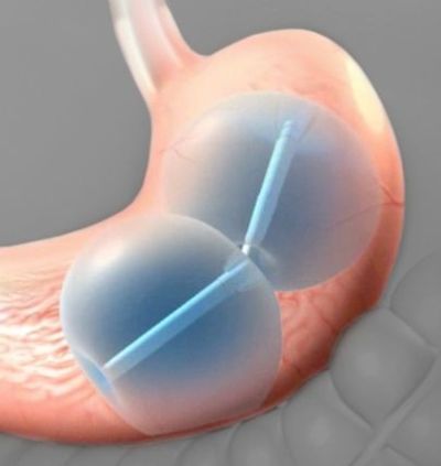 Балон в желудке FDA