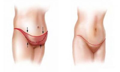 Удаление жирового фартука на животе