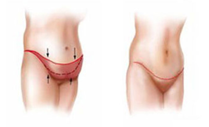 Удаление жирового фартука на животе