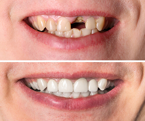 Восстановление зубов до и после