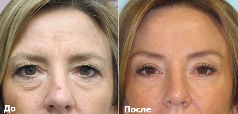 Эндоскопический лифтинг лба