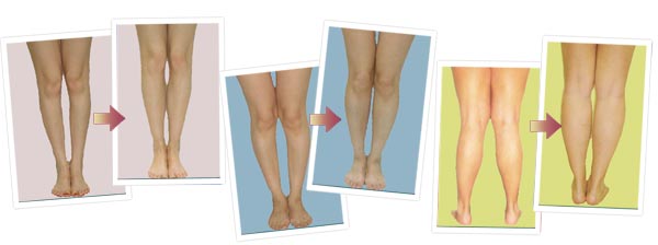 Коррекиция формы ног