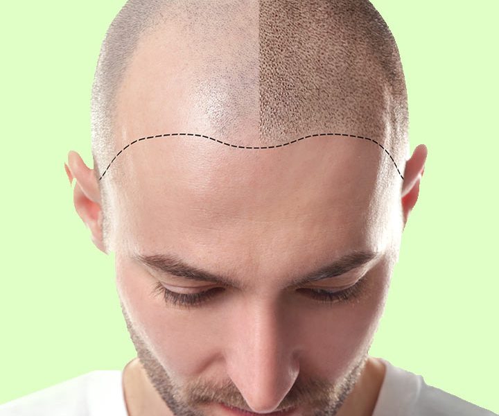 ​FUE пересадка волос: инновационное решение для проблемы облысения