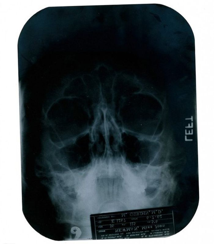 Рентгеновский снимок головы Мэрилин Монро
