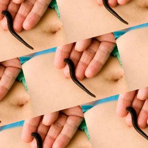 Лечение бесплодия пиявками