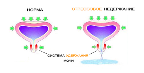 Стрессовое недержание мочи у женщин