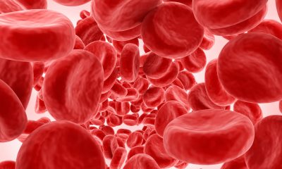 Терапия агрессивной формы лимфомы