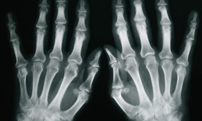 Псориатический артрит рентген
