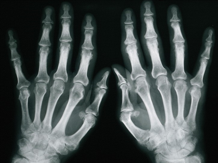 Псориатический артрит рентген