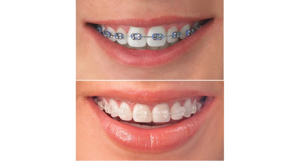 Брекет-системы