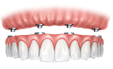 All-on-four импланты зубов