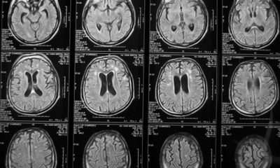 Показания для проведения МРТ головного мозга