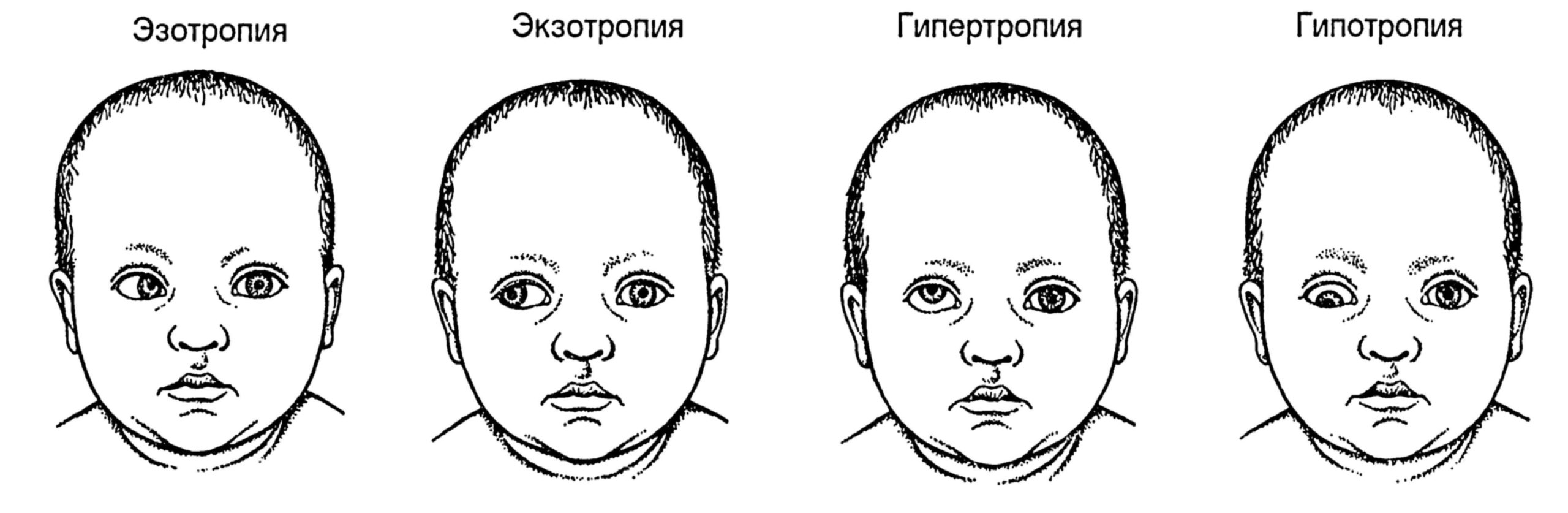 сходящееся косоглазие код по мкб 10