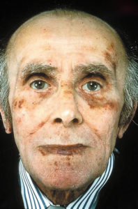Классические черты лица при амилоидозе с кровотечением под кожей (синяки) вокруг глаз