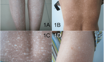 Особенности кожи при амилоидозе кожи