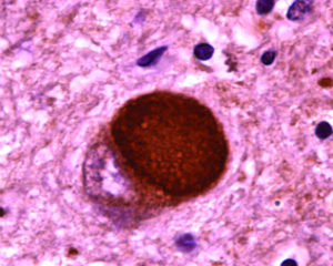 Микроскопическое изображение тельца Леви.