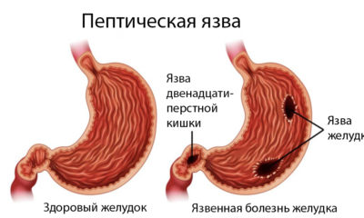 Пептическая язва как выглядит и что это такое