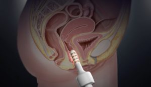 Воздействие квадриполярным RF-прибором EVA