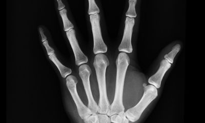 Рентгенография кисти руки