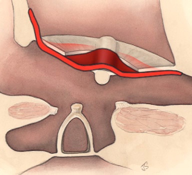 Тимпанопластика
