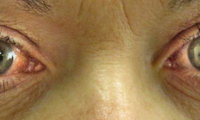 Острая закрытоугольная глаукома правого глаза