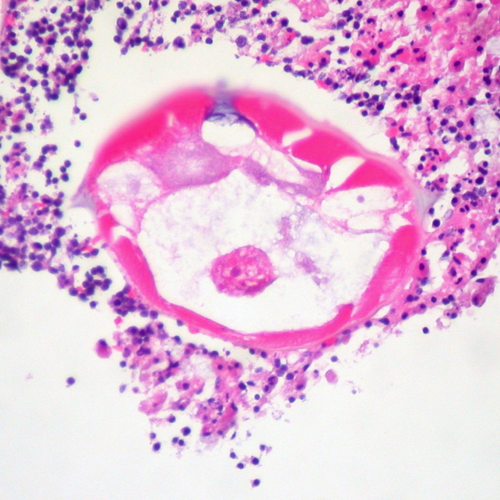 Острицы (энтеробиоз) в просвете червеобразного отростка