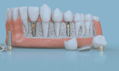Имплант зубов