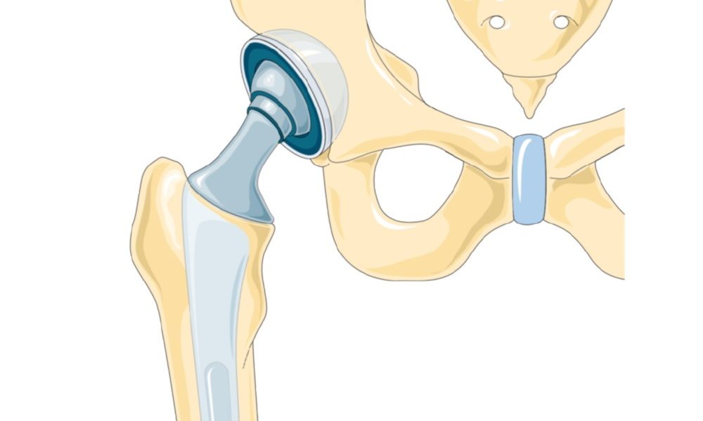 Замена сустава шейки бедра