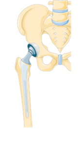 Замена тазобедренного сустава