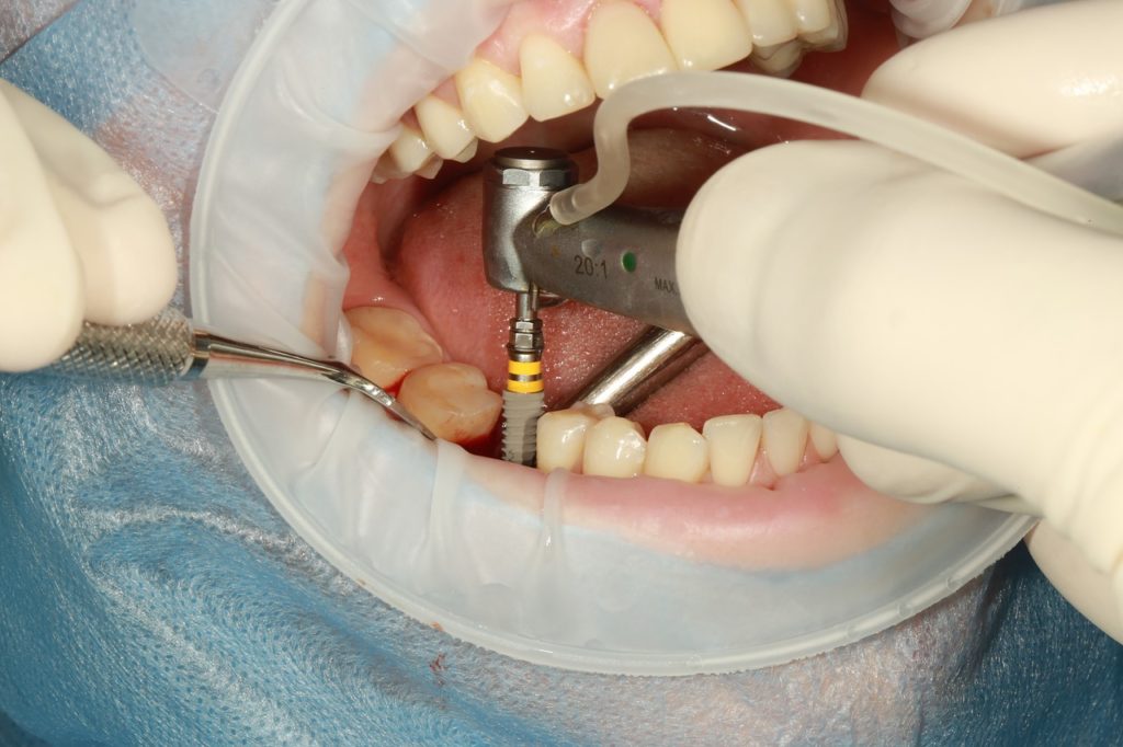 Имплантация зубов Зубы Стоматология