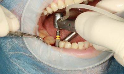Имплантация зубов Зубы Стоматология