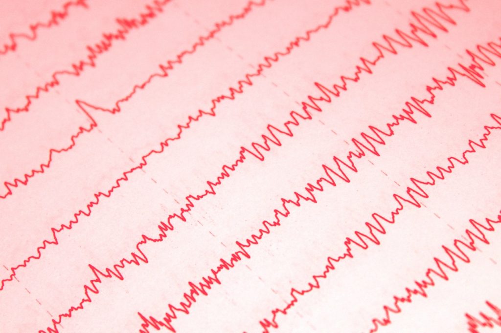 Диагностика Электроэнцефалография