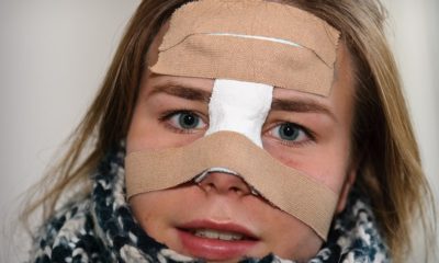 Перелом носа