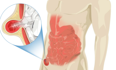 Паховая грыжа