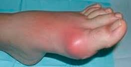 Симптомы подагры