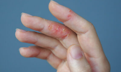 Атопический дерматит Экзема на пальцах
