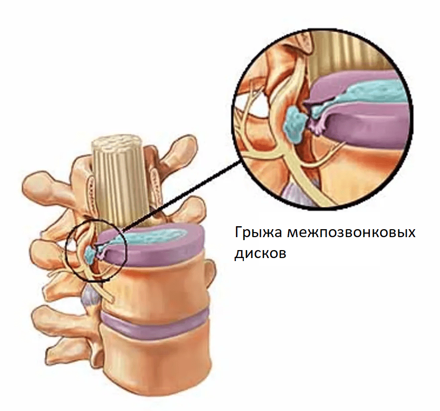 Грыжи межпозвоночных дисков