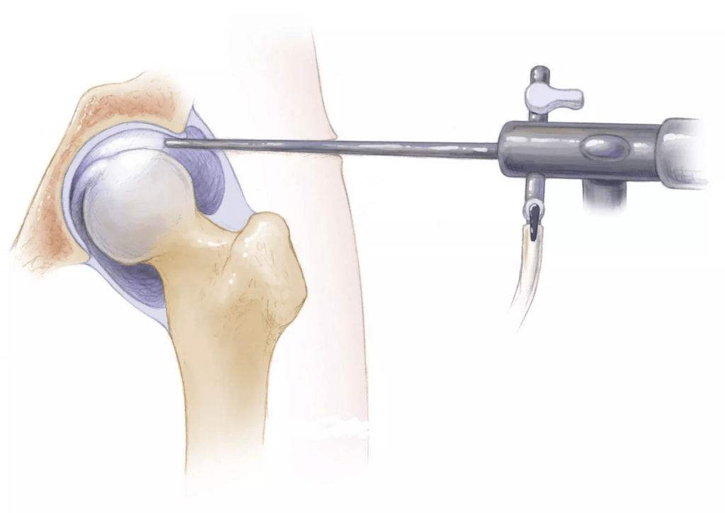 Артроскопия тазобедренного сустава
