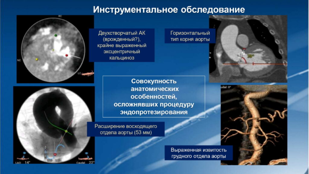 Аномалии аорты пациента