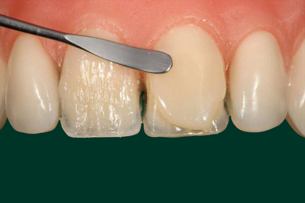 Композитные виниры