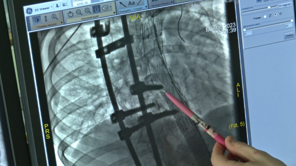 Снимок МСКТ, показывающий опасную картину до операции