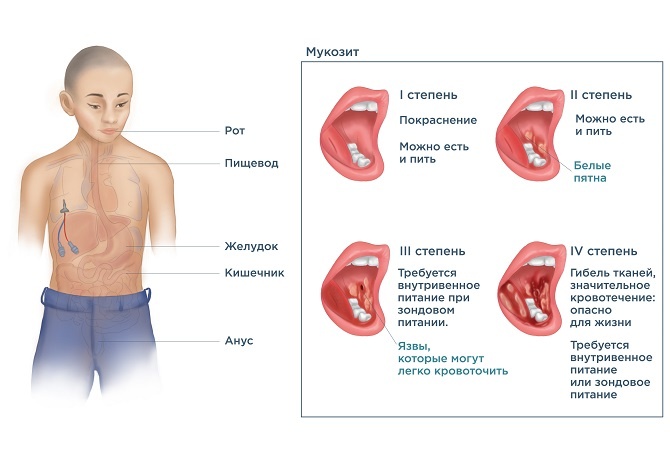 Оральный мукозит
