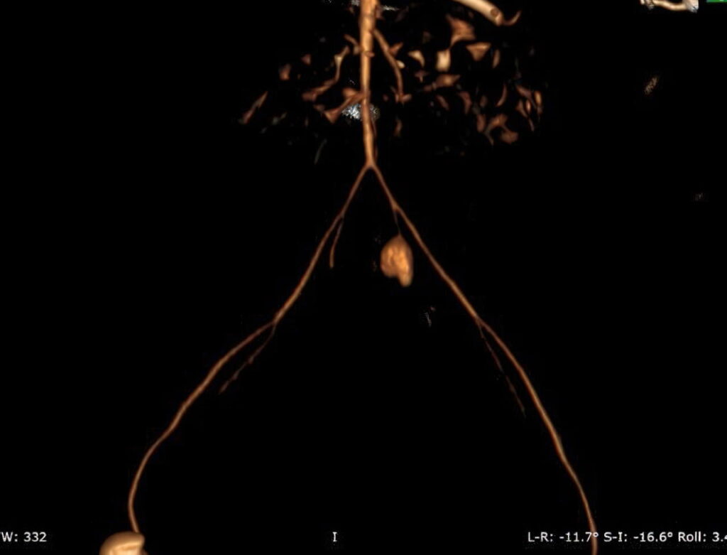 МСКТ-снимок - аневризма подвздошной артерии