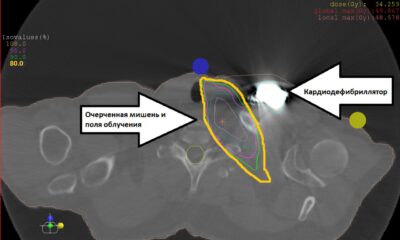 НМИЦ Мешалкина. Снимок пациента с отображением полей облучения и кардиостимулятором