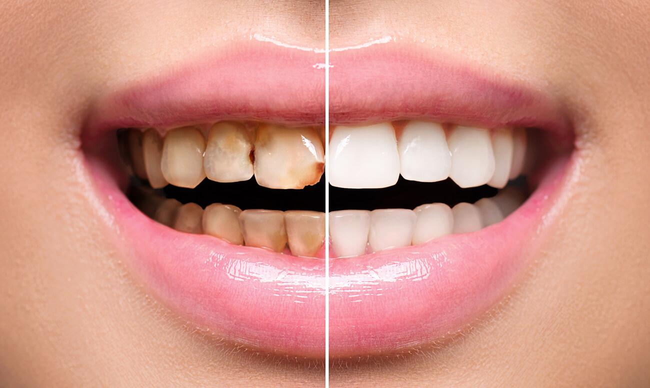 Что делать, если зуб потемнел после травмы?