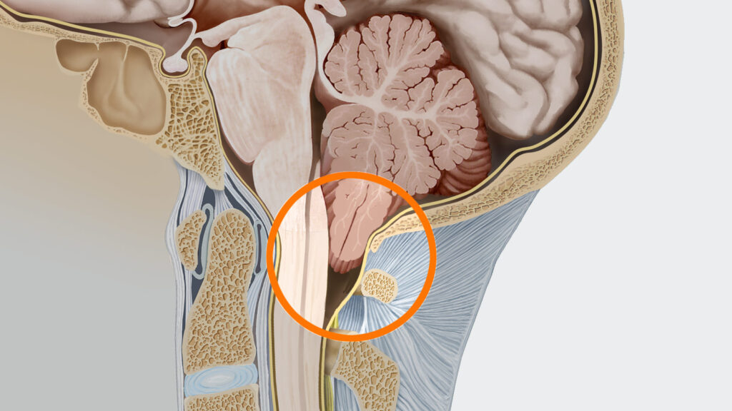 Лечение редкого заболевания - аномалии Арнольда-Киари